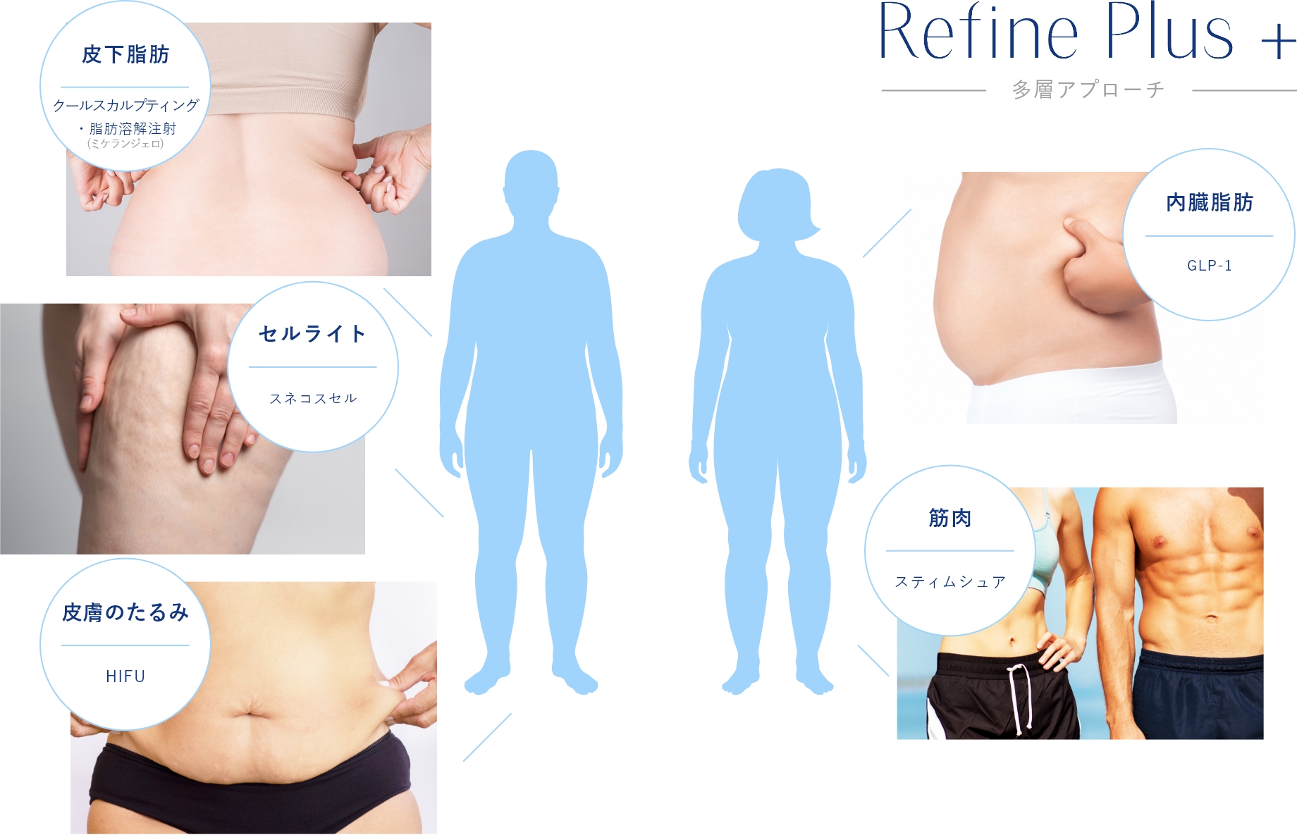 Refine Plus＋の多層アプローチ概念図。皮下脂肪（クールスカルプティング）、内臓脂肪（GLP-1）、筋肉（スティムシェア）、皮膚のたるみ（HIFU）、セルライト（スネコスセル）へ層別にアプローチする図