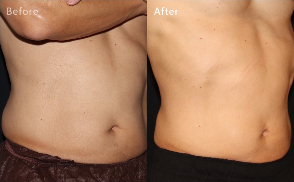 症例写真5（Before/After）