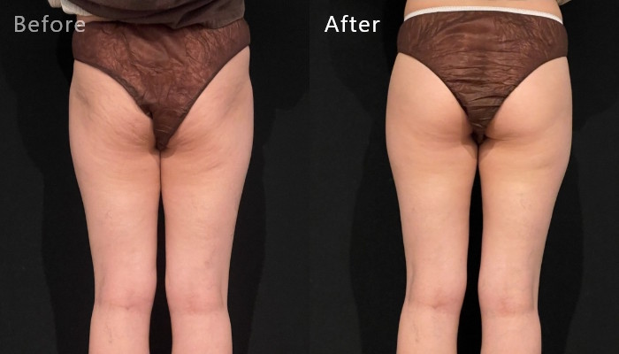 太ももの施術例