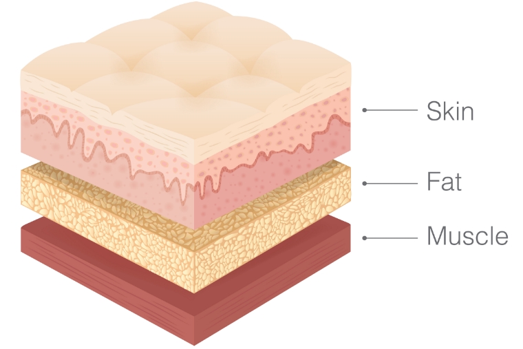 皮膚・脂肪・筋肉の多層構造を示すイラスト