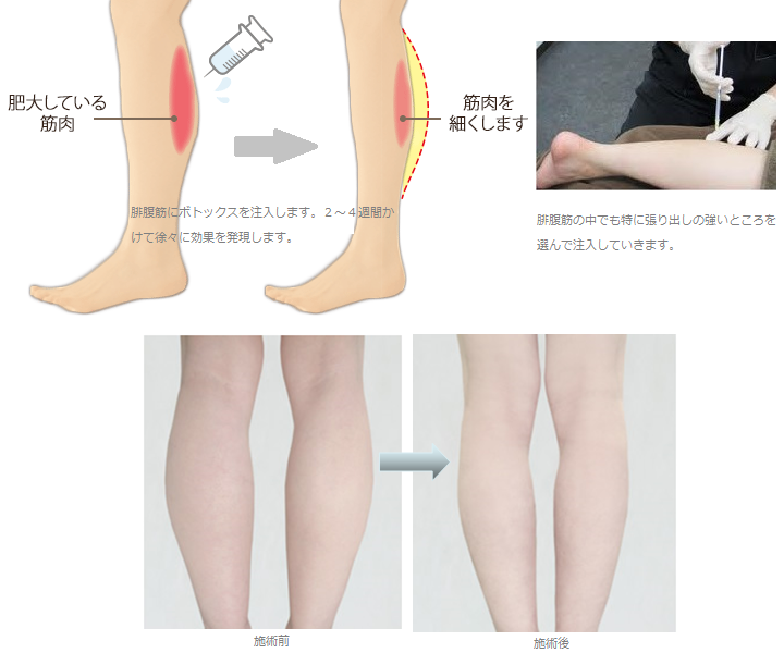 美脚ボトックス Kumiko Clinic クミコクリニック 東京 日比谷