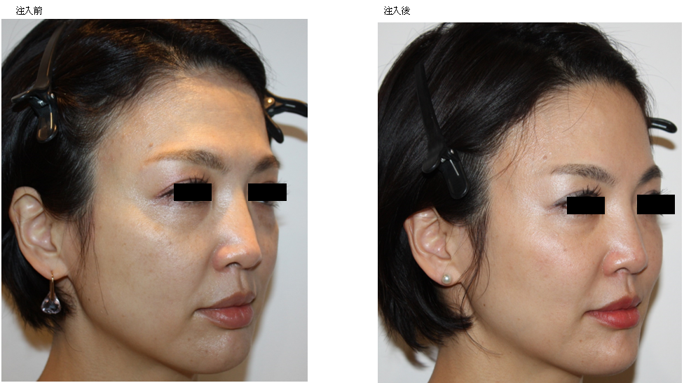 顎 ができて嬉しいです 顎 の効果とは Kumiko Clinic クミコクリニック 東京 日比谷