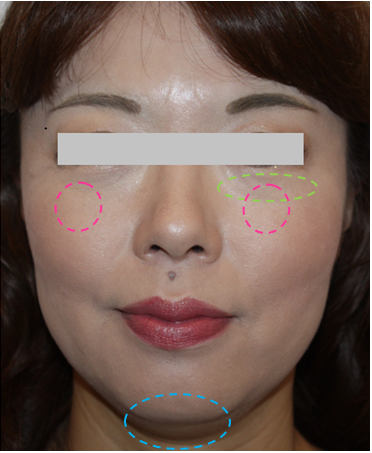 顎 ができて嬉しいです 顎 の効果とは Kumiko Clinic クミコクリニック 東京 日比谷