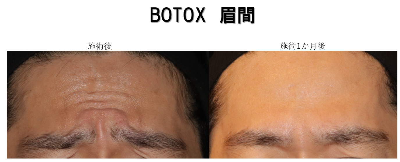 男性美容 ボトックスでイケメンに Kumiko Clinic クミコクリニック 東京 日比谷
