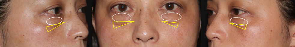 治療プランを細かく説明 しわ たるみ編 Kumiko Clinic クミコクリニック 東京 日比谷