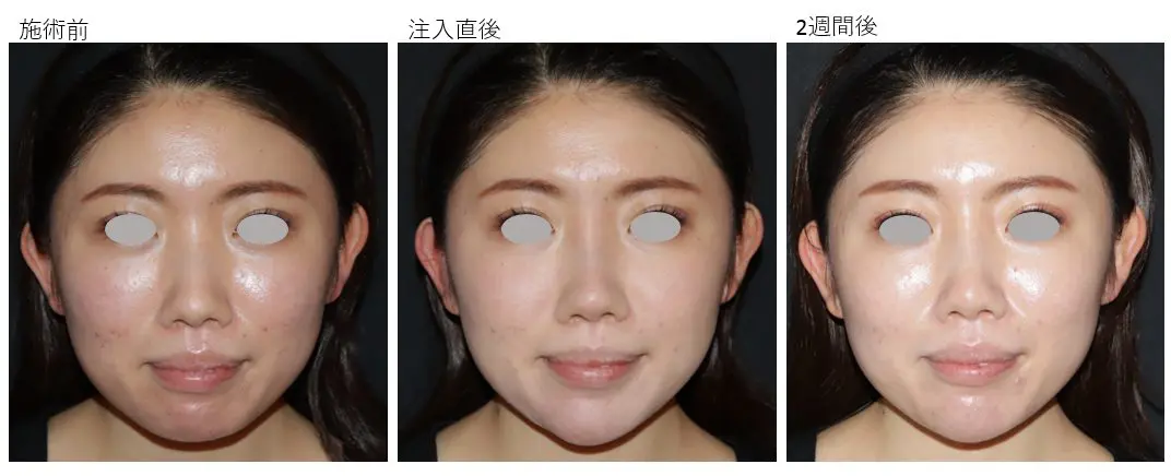 ヒアルロン酸 顎 鼻注入で洗練された美人に Kumiko Clinic クミコクリニック 東京 日比谷