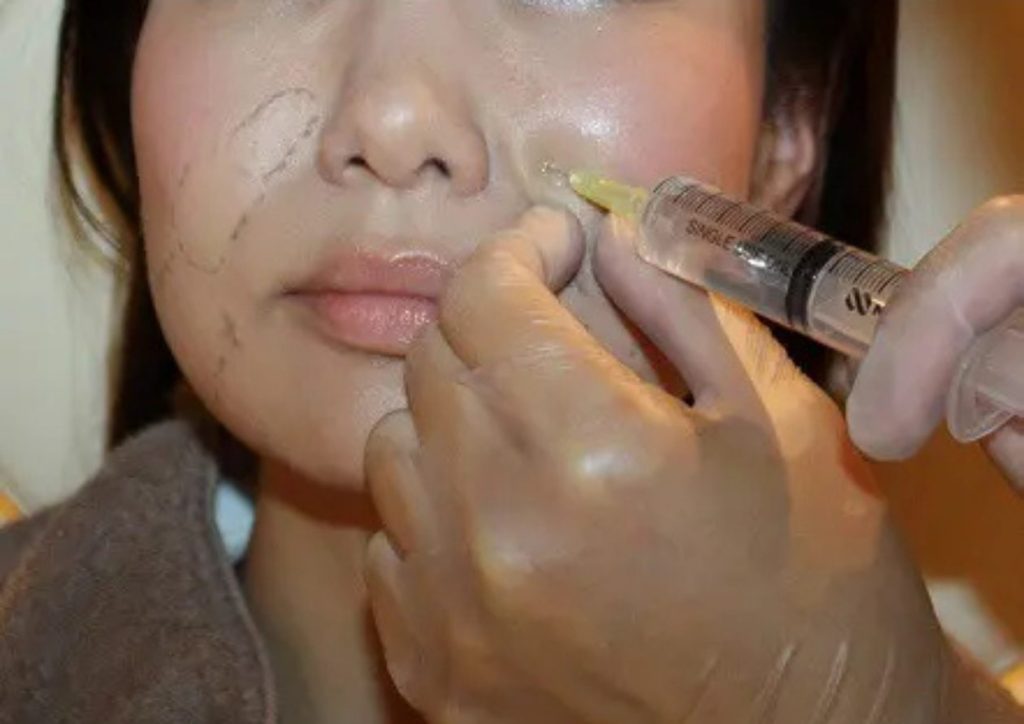 脂肪溶解注射マーキング写真