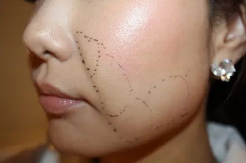 脂肪溶解注射マーキング写真