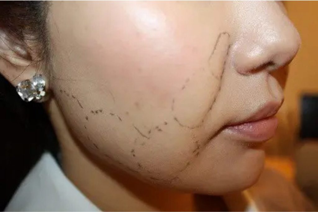 脂肪溶解注射マーキング写真