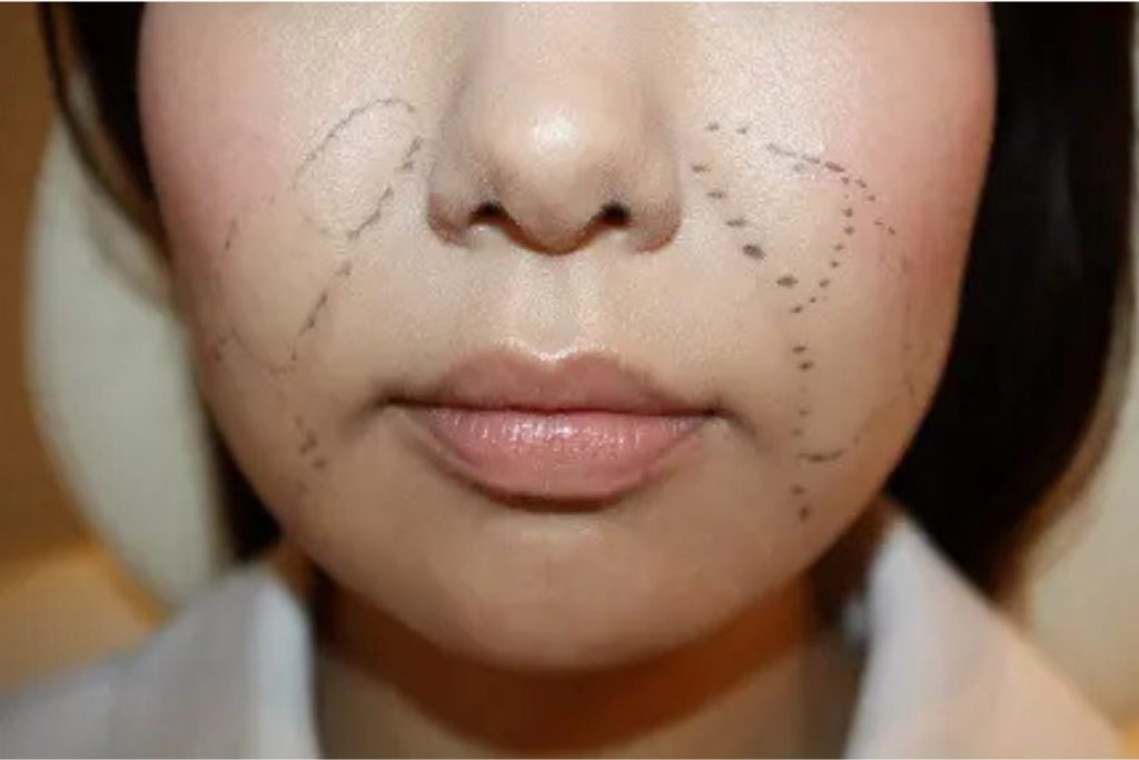 脂肪溶解注射マーキング写真