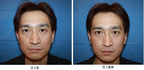 ヒアルロン酸 ほうれい線 男性 Kumiko Clinic クミコクリニック 東京 日比谷